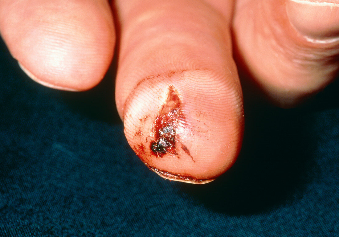 Close up of a lacerated (cut) and crushed finger