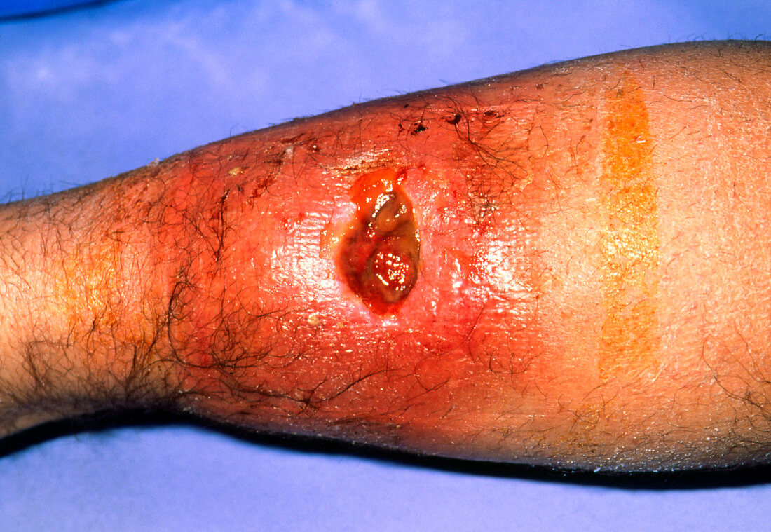 Close-up of an infected haematoma on man's leg