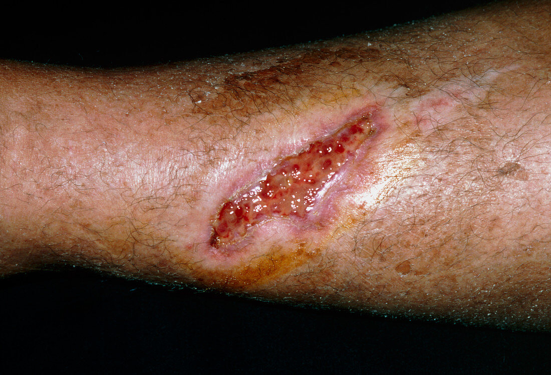 Wound healing six weeks after elderly woman's fall