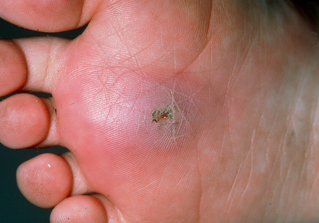 Sole of foot infected due to foreign body