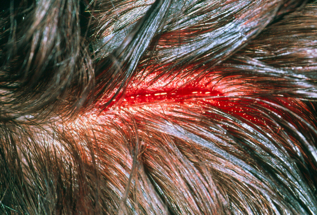 Lacerated scalp of a 40 year old man