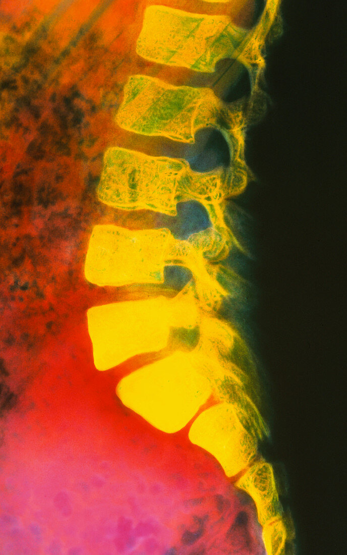 Coloured X-ray of spondylolisthesis in sp