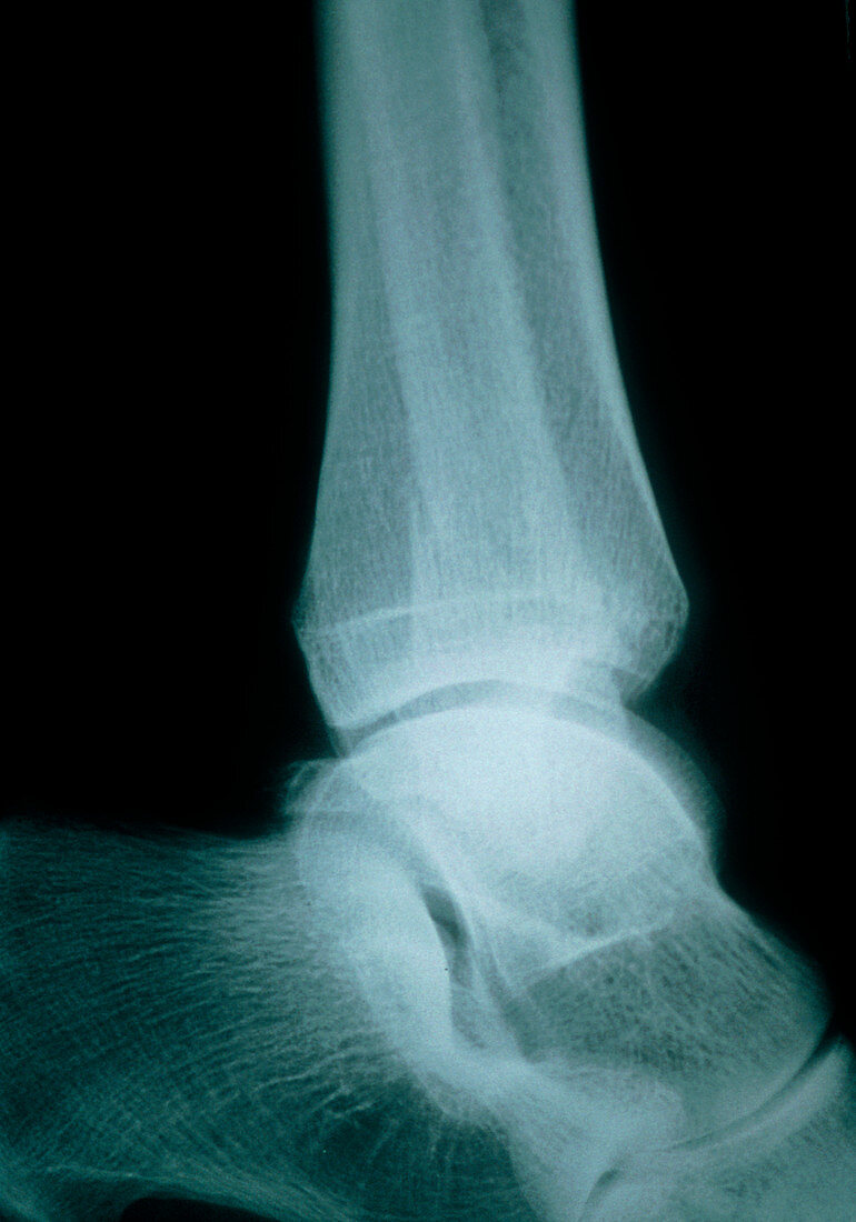 X-ray of an elderly woman's fractured fibula bone