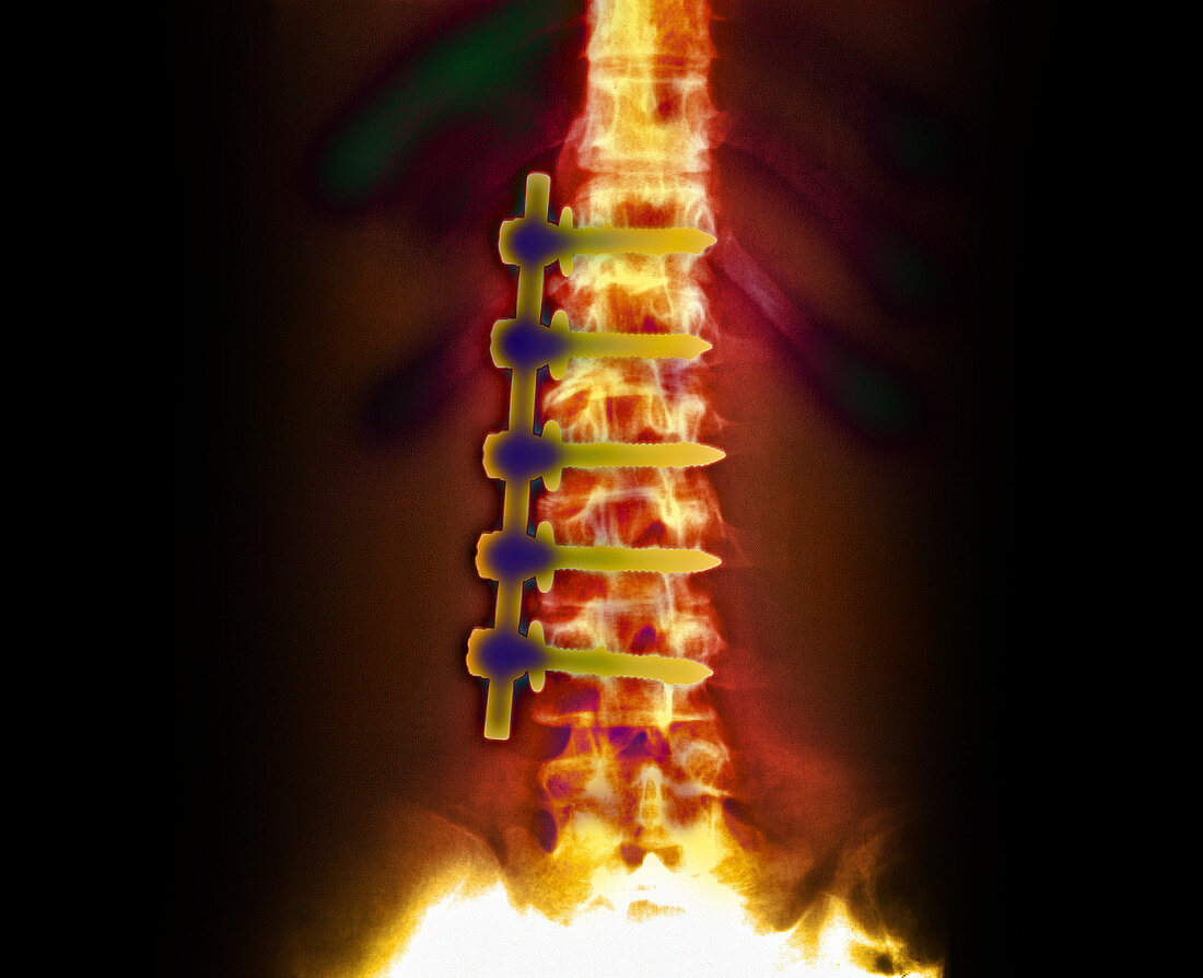 Coloured X-ray of corrected scoliosis of the spine
