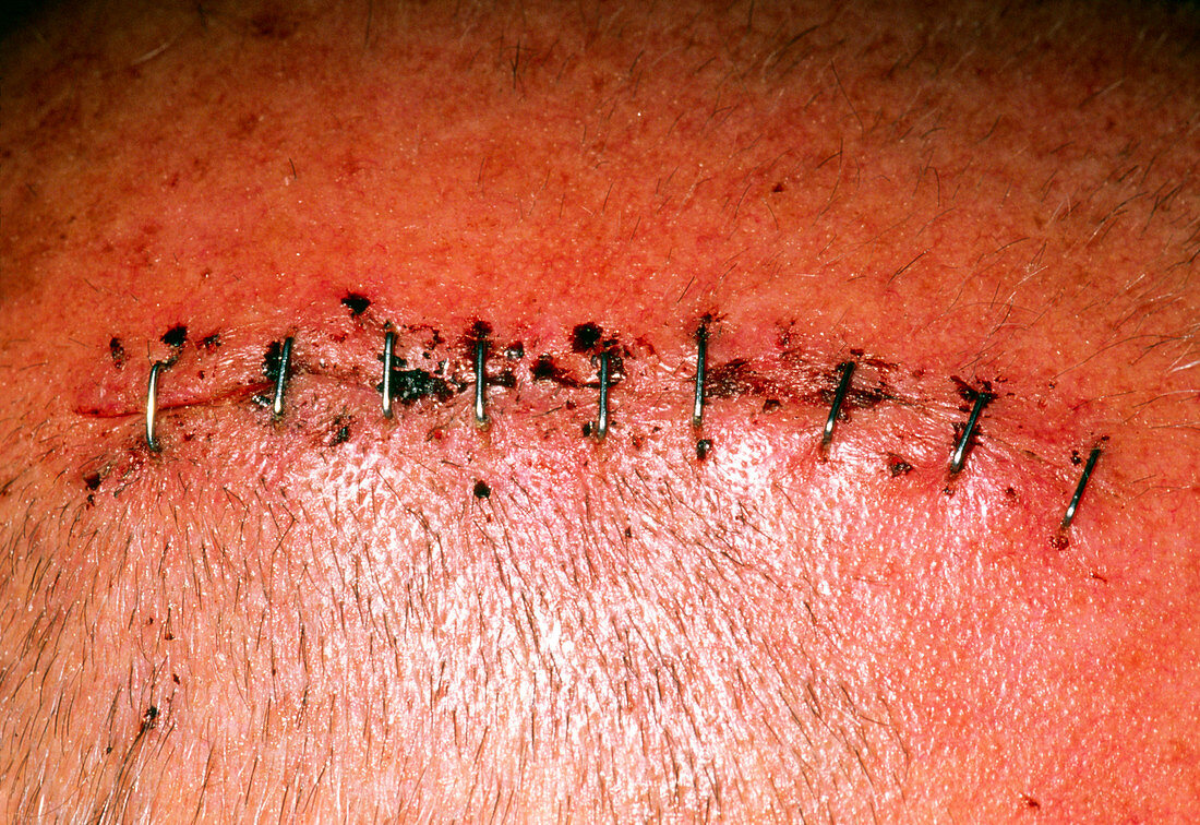 Metal staples closing a wound on a man's head