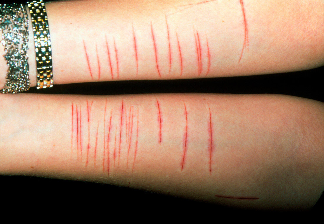 Self-inflicted lacerations on teenage girl's arms