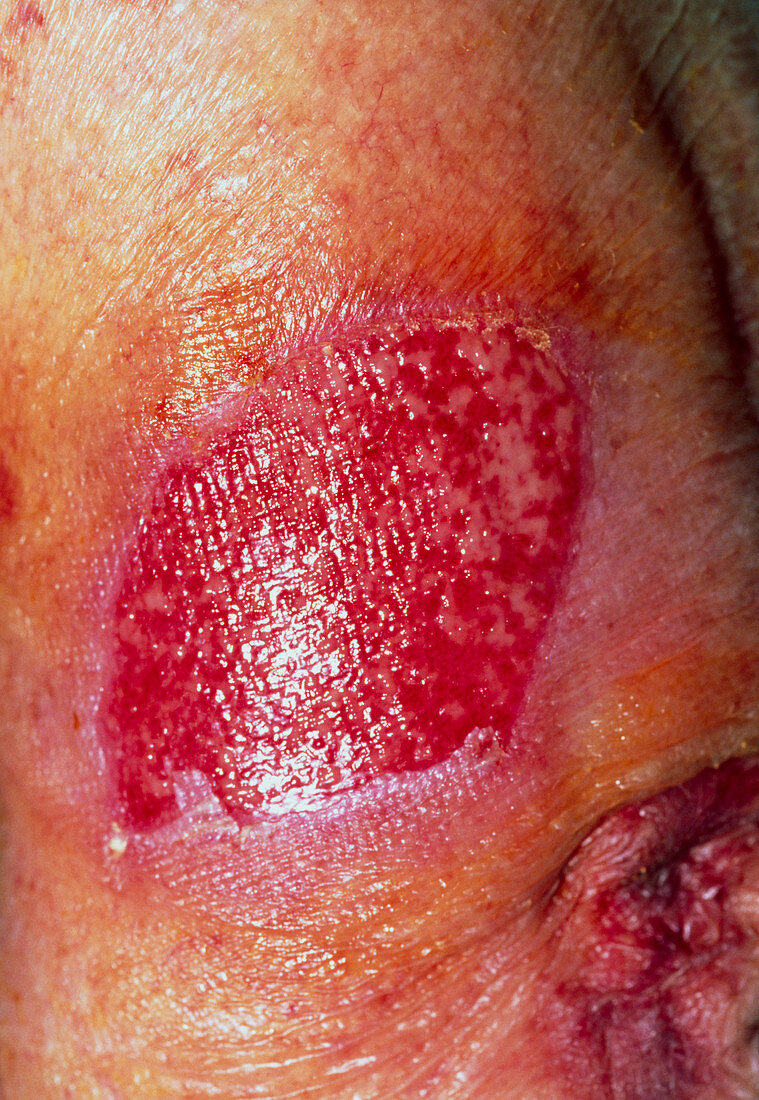 Skin loss on an elderly woman's arm after a trauma