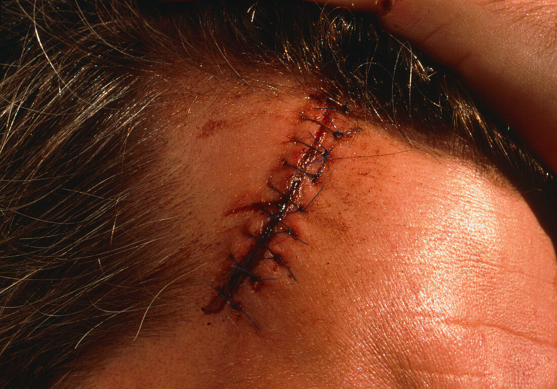 View of a sutured laceration on a man's scalp