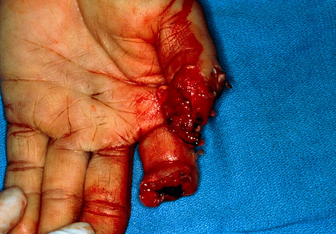 Injured hand due to crushing