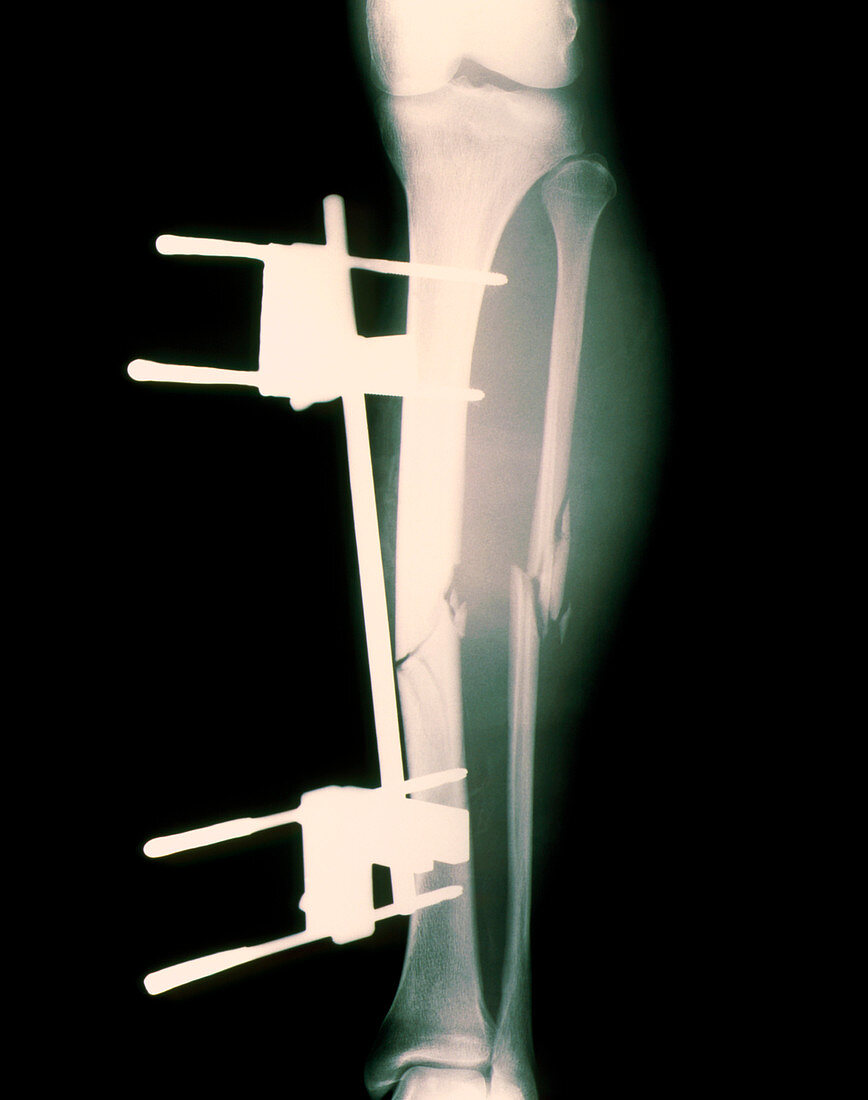 Pinned broken leg