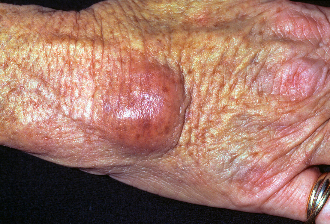 Haematoma on hand