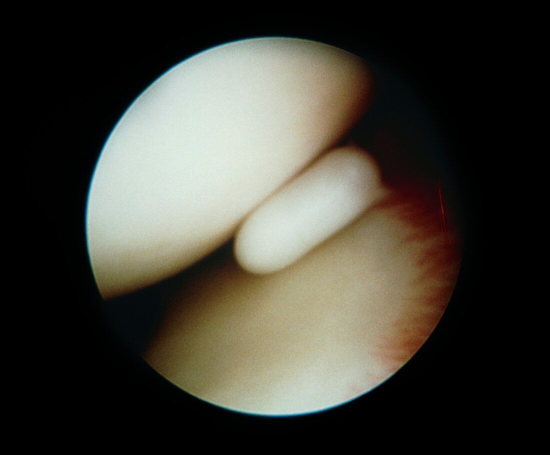 Knee foreign body