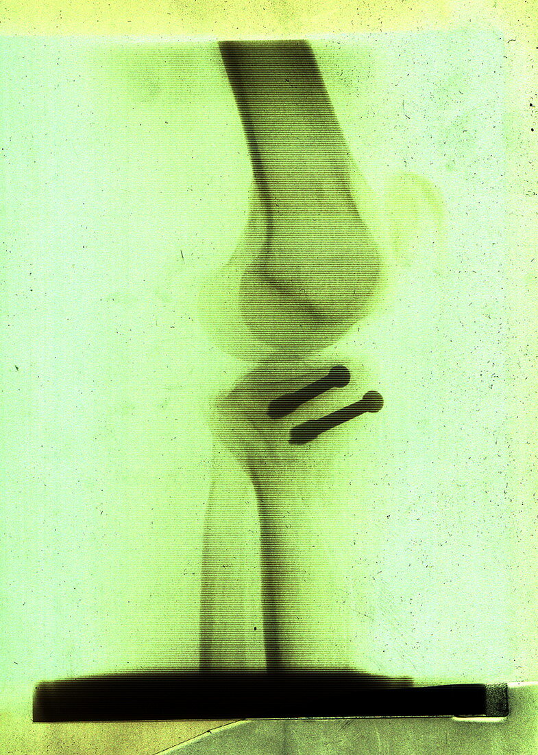 Knee fracture,X-ray