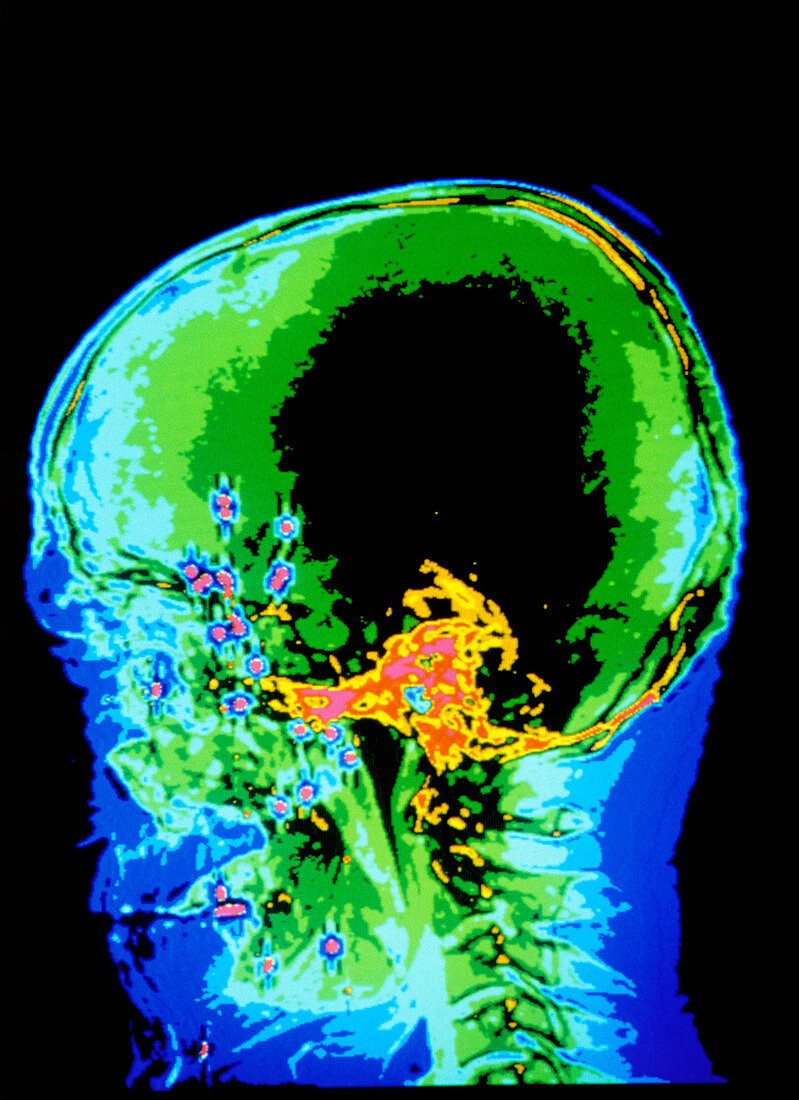 Coloured CT scan showing lead shots within skull