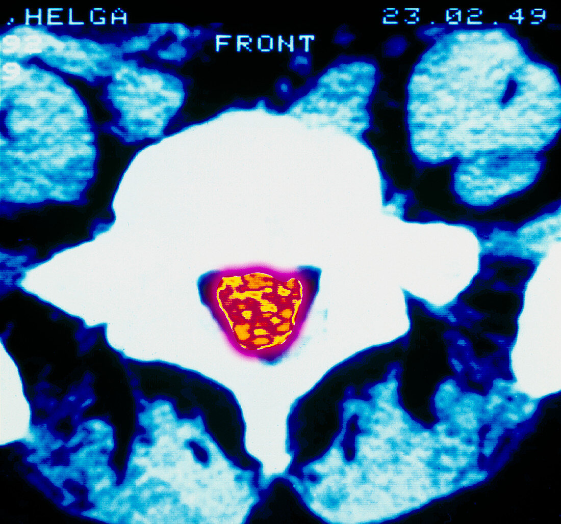 CT scan of spinal cord in vertebral disc hernia
