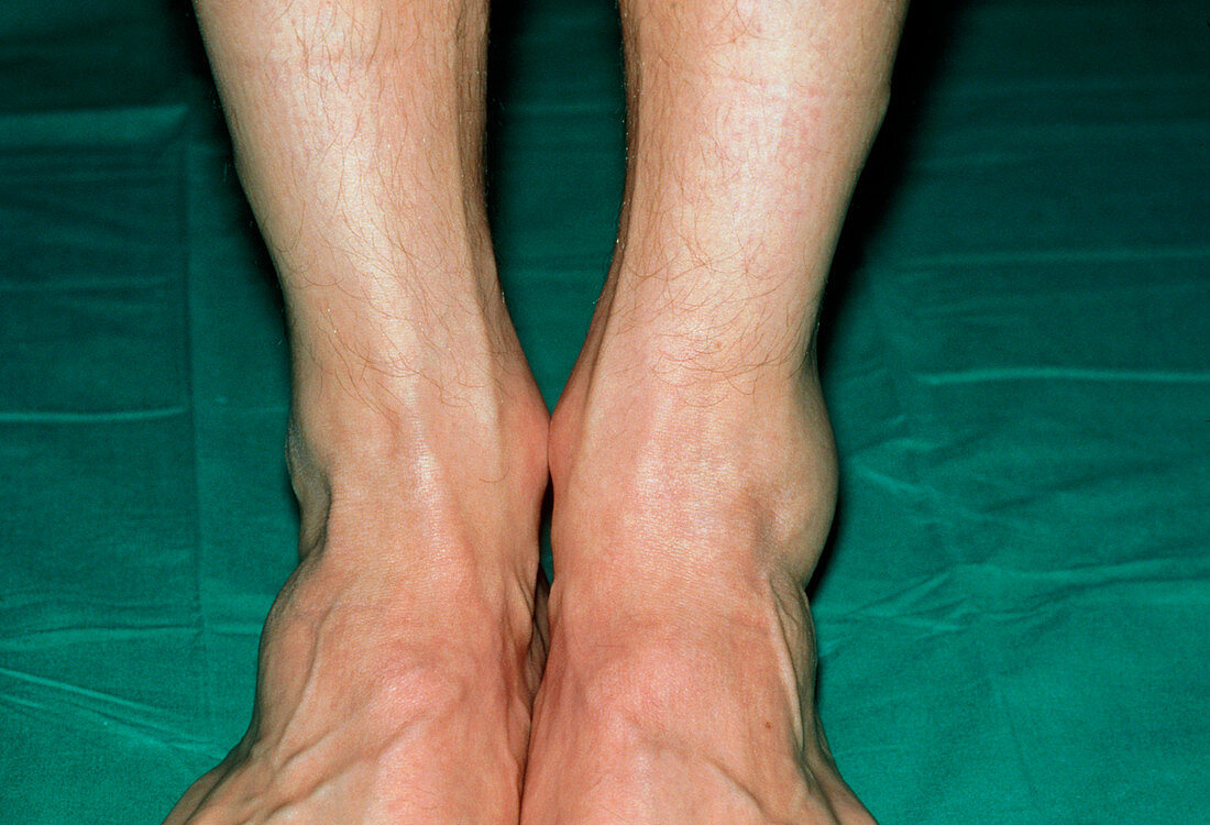 View of swollen left ankle due to sprain