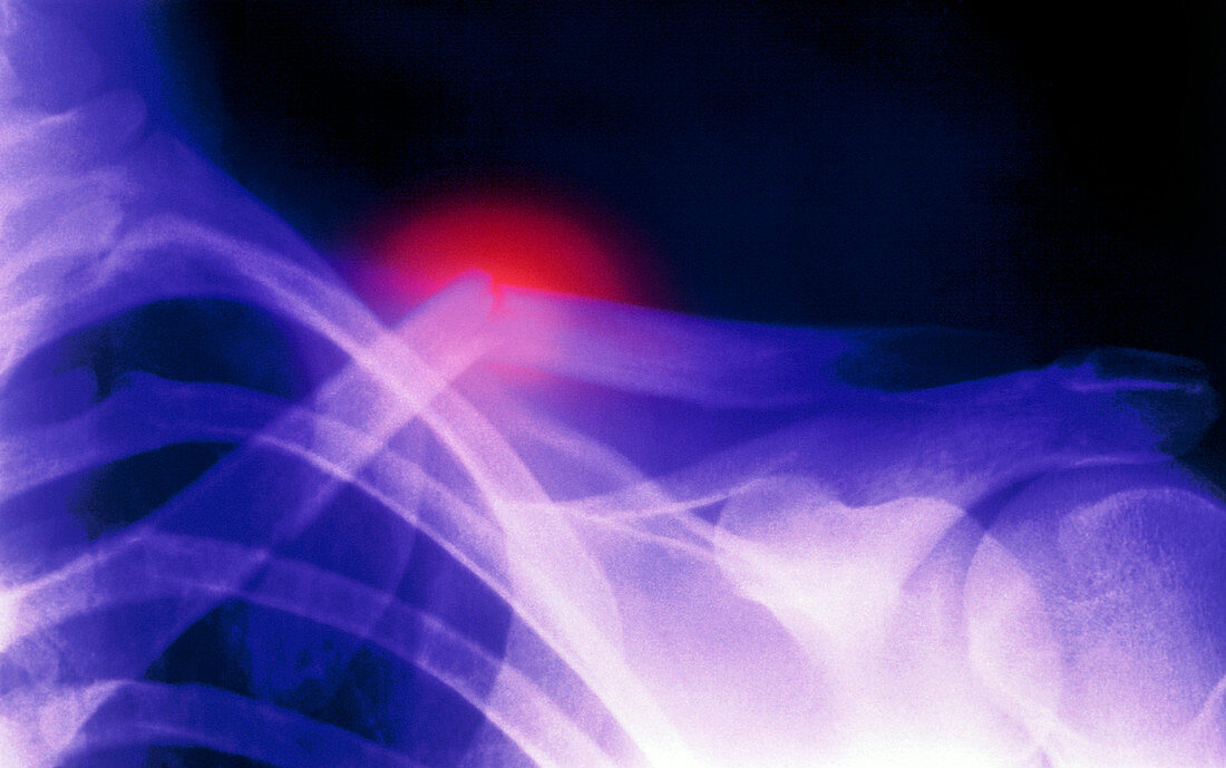Col X-ray image showing a fractured clavicle