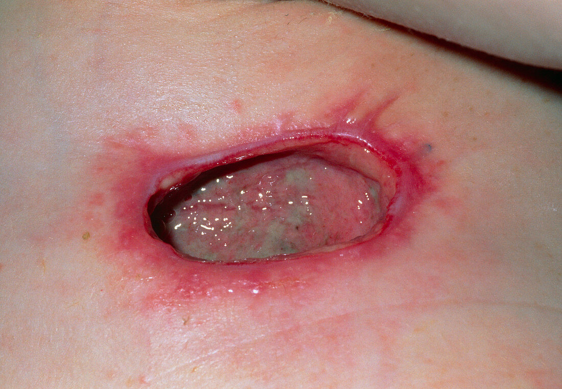 Wound infection in armpit after sympathectomy