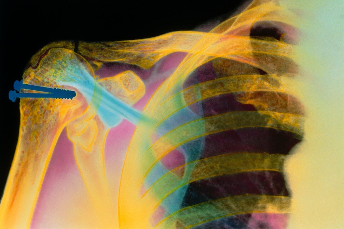 Coloured X-ray of a fractured humerus