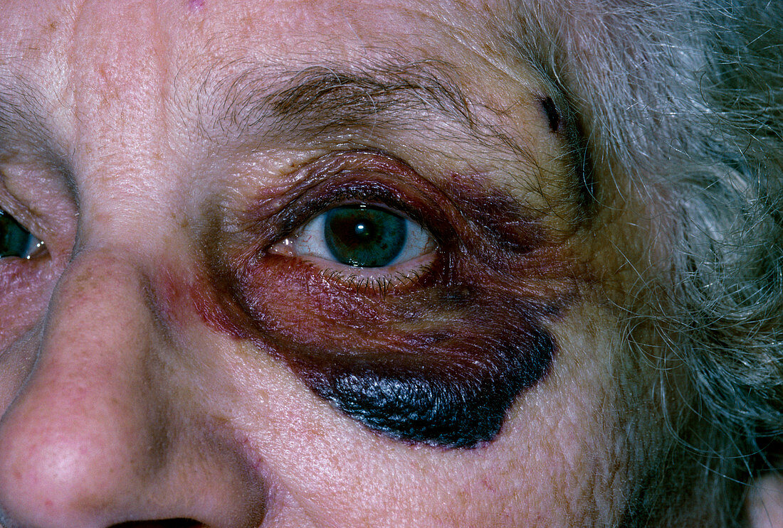 Close-up of black eye in elderly woman