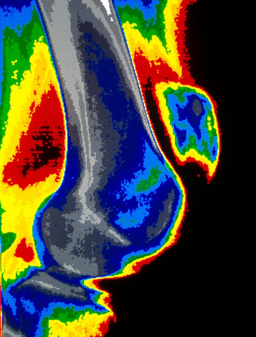 Coloured X-ray of dislocated kneecap