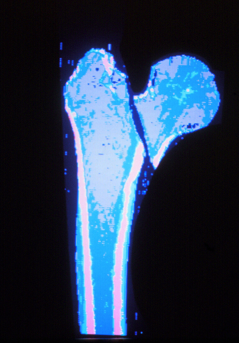 Coloured CT scan of fractured femur (broken hip)