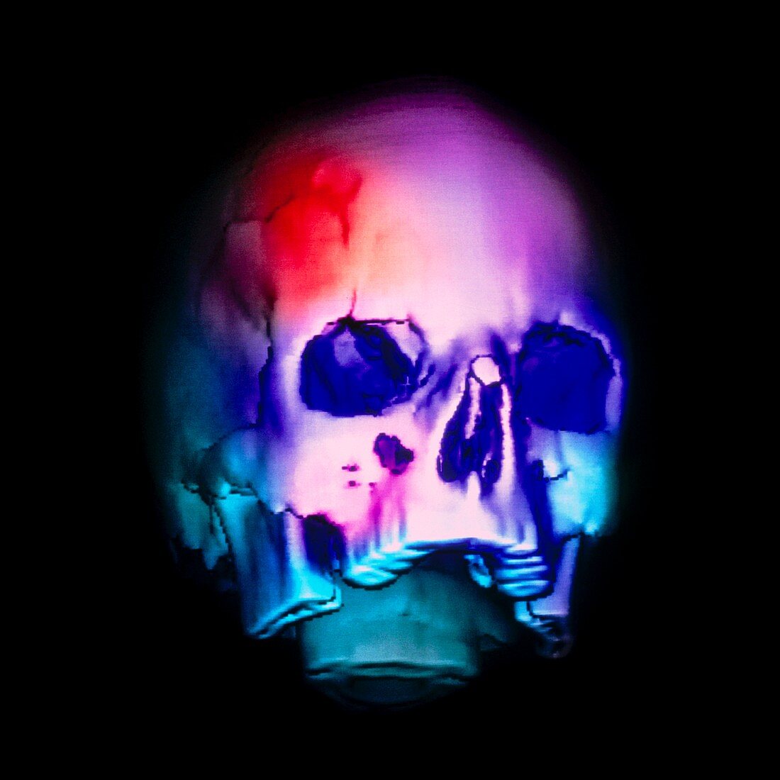 Coloured 3-D CT scan of a fractured skull