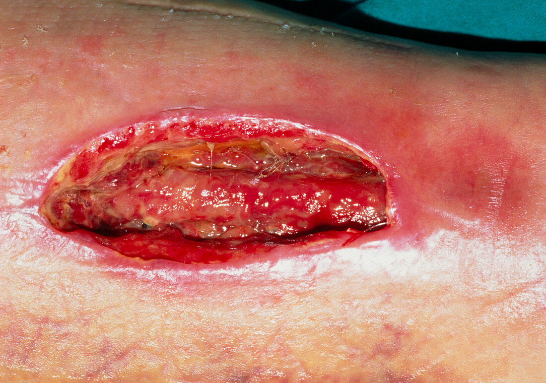 Close up of an open and infected leg wound