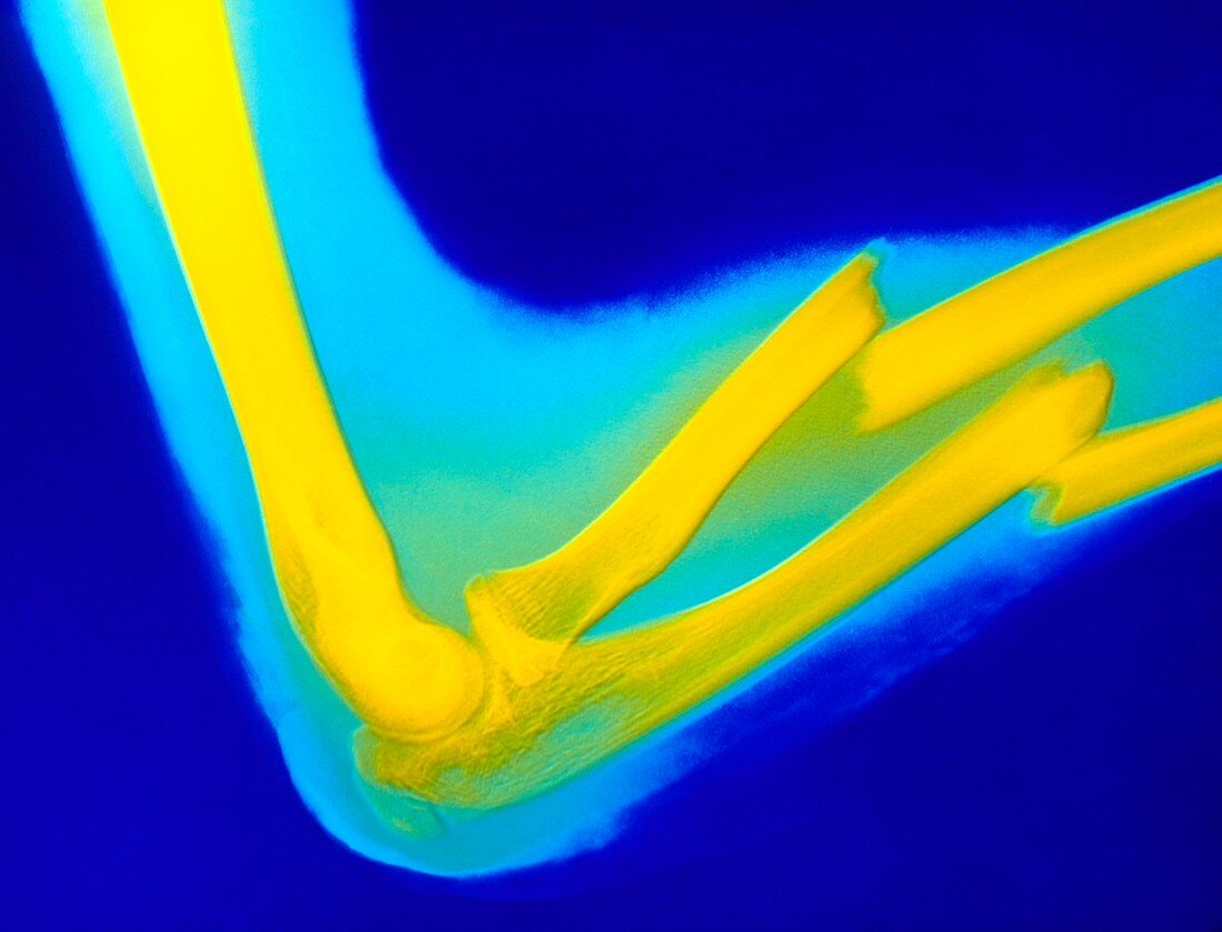 Coloured X-ray of fractured ulna radius a