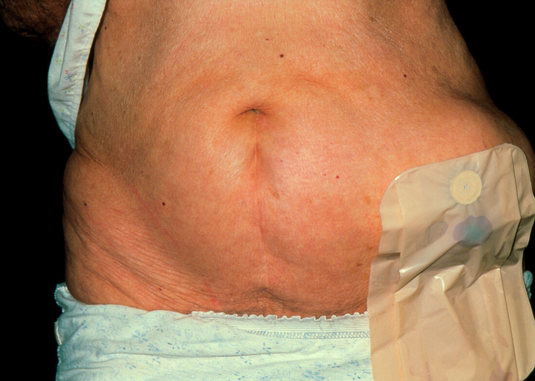 Incisional hernia & colostomy bag on old woman