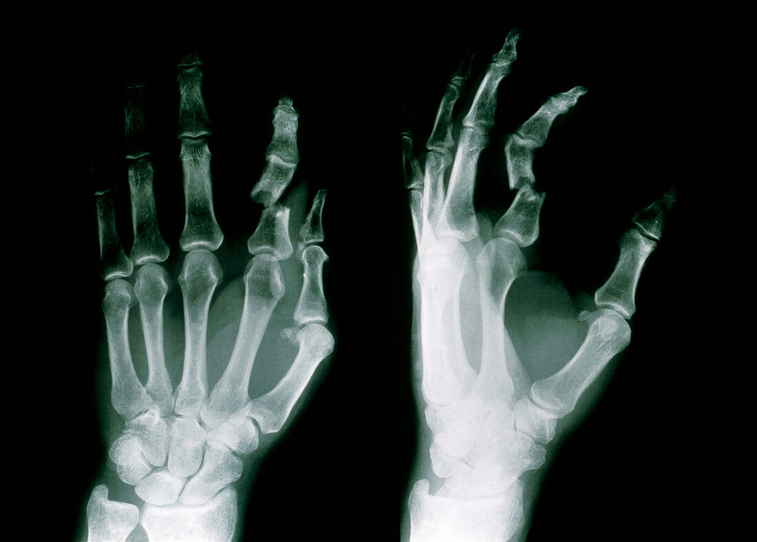 X-ray of fractured forefinger (phalanx) of hand