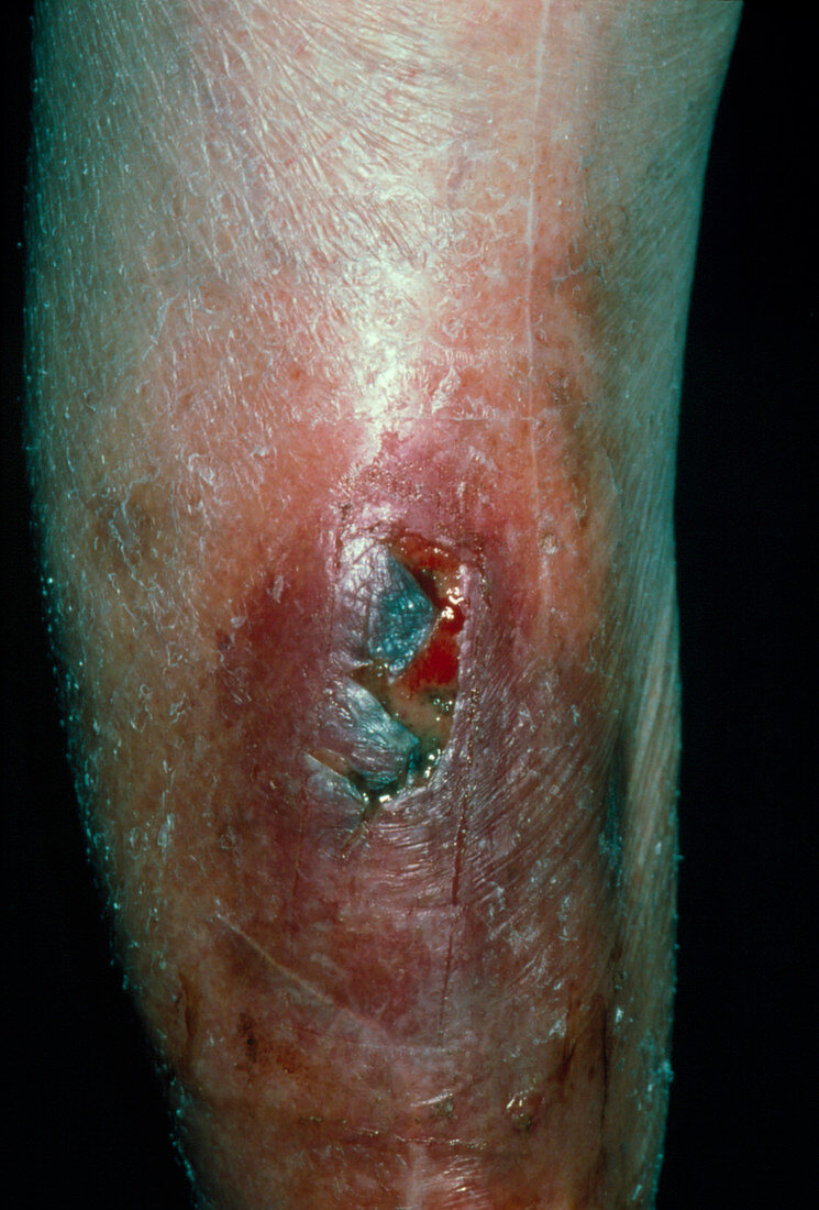Infected wound on arm caused by rose-thorn