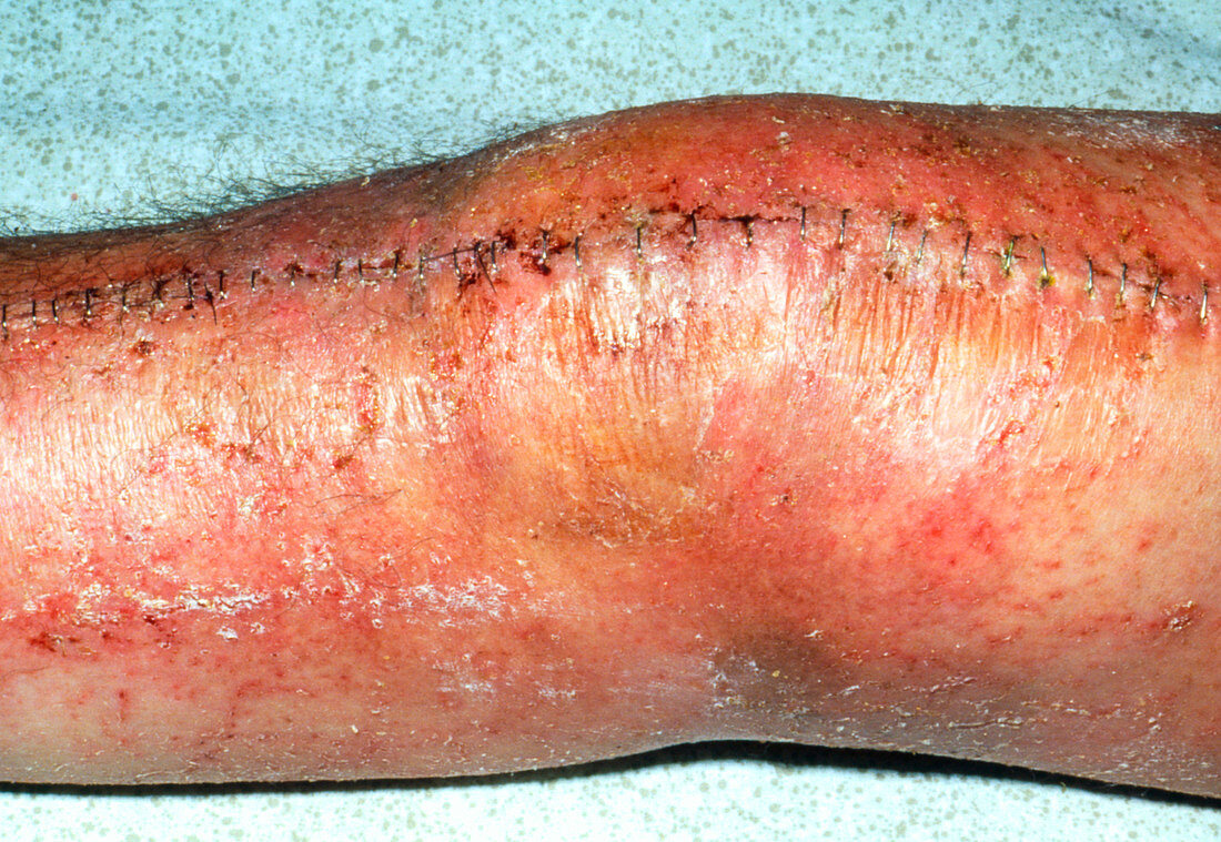 Sutured knee showing metal staples and psoriasis