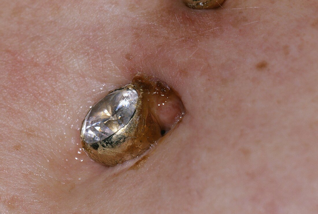 Infected navel piercing