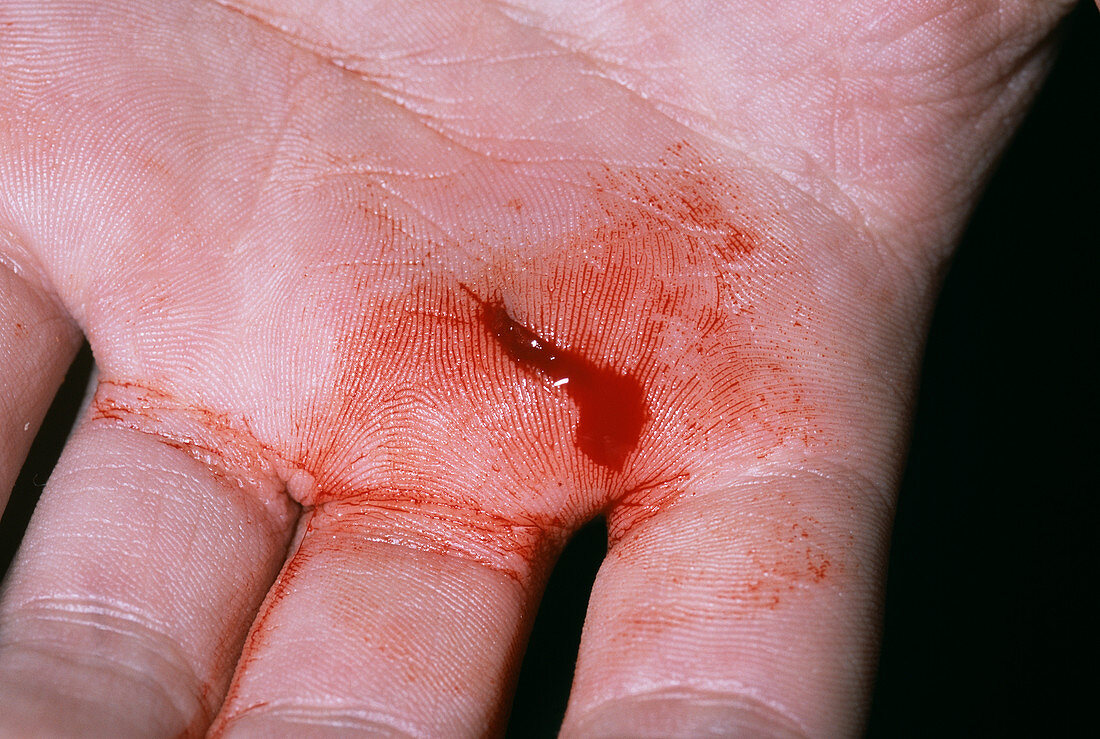 Knife wound