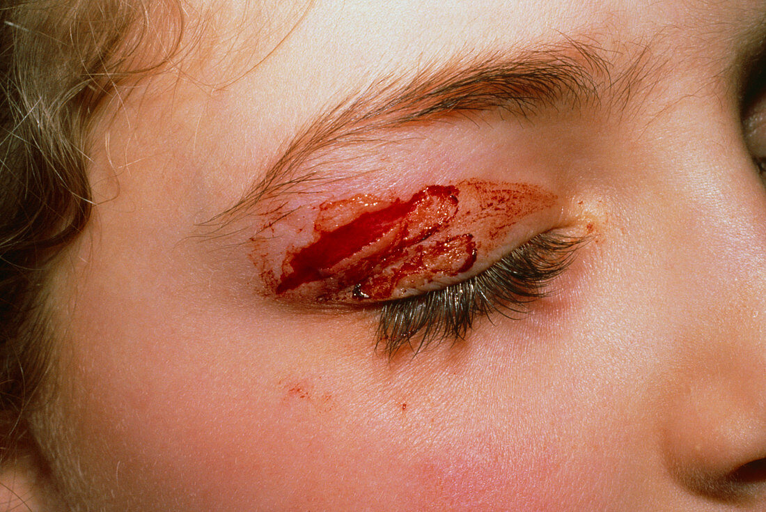 Cut eyelid