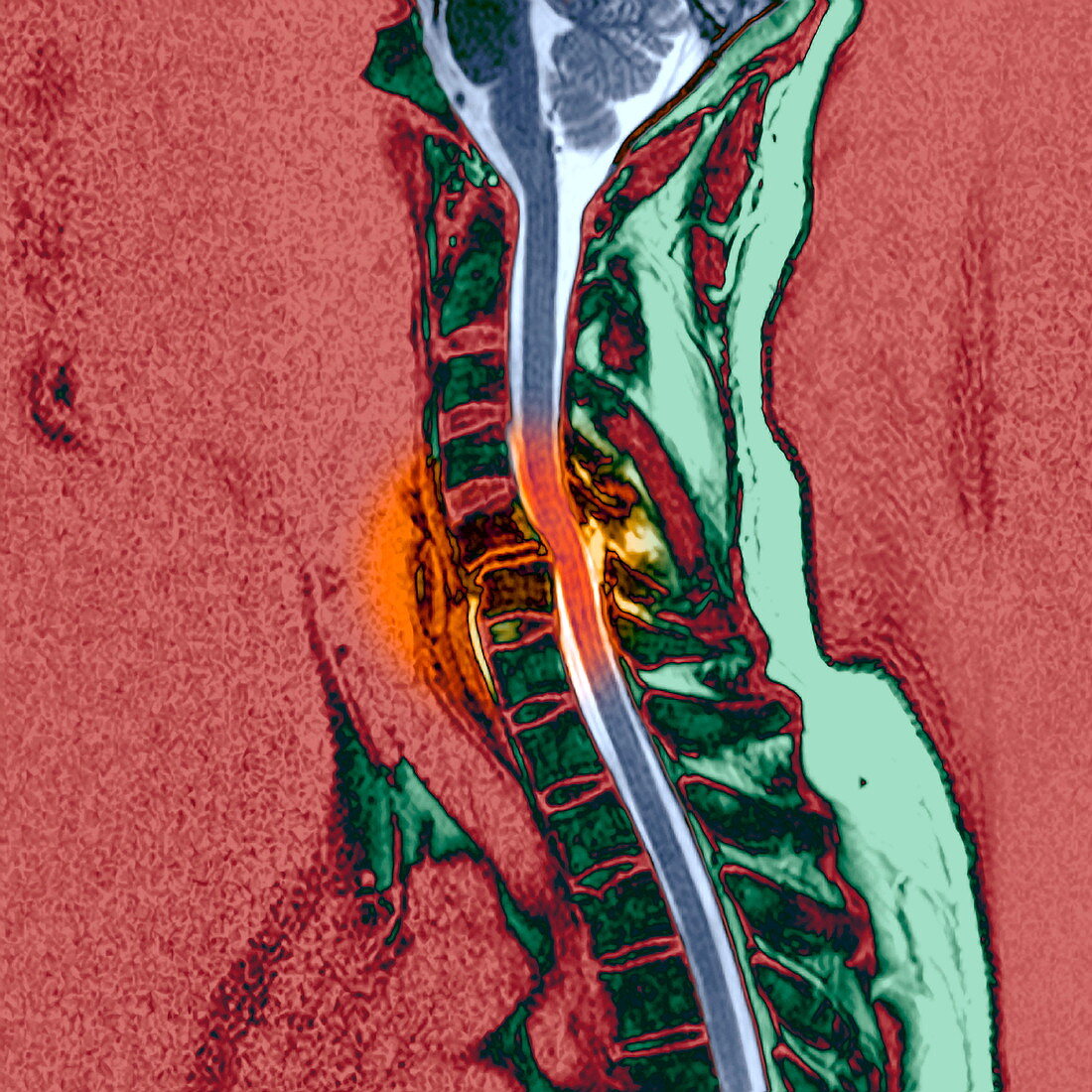 Broken neck,MRI