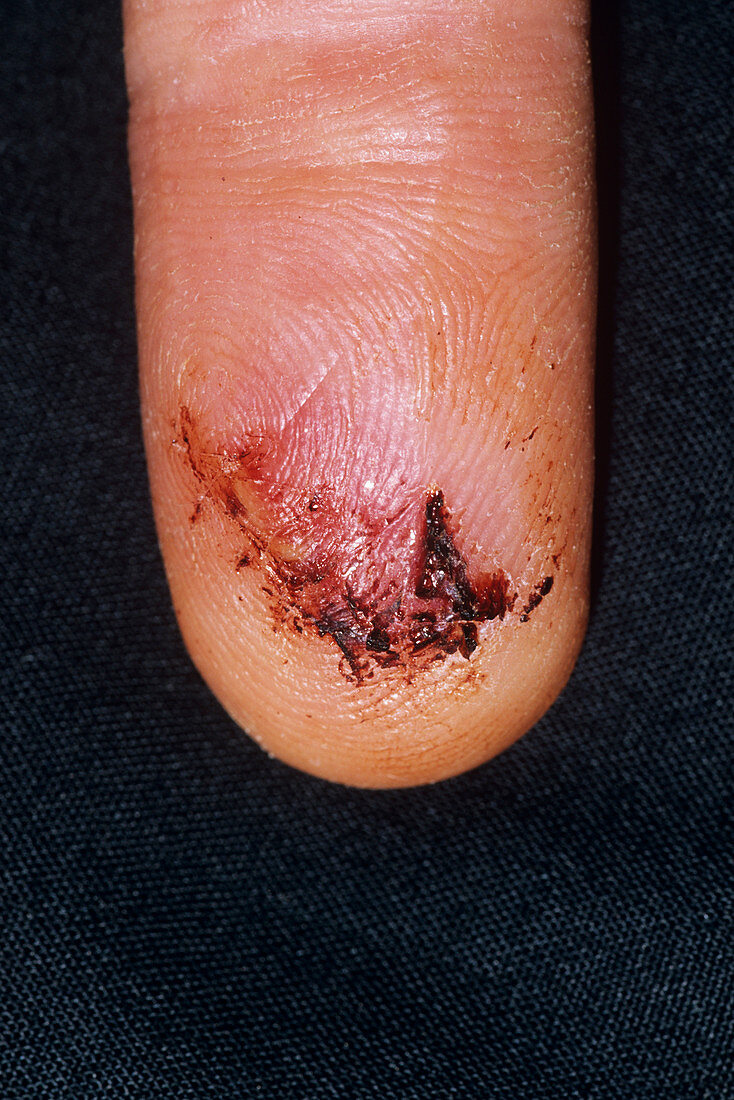 Lacerated finger