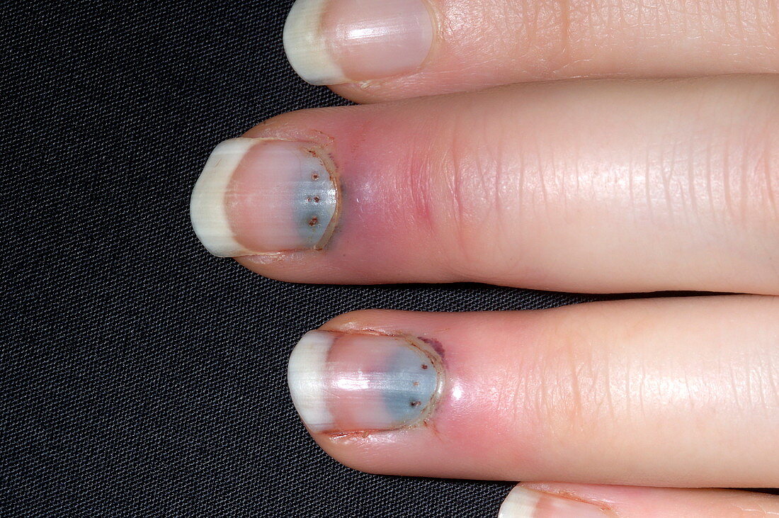 Bleeding under finger nails