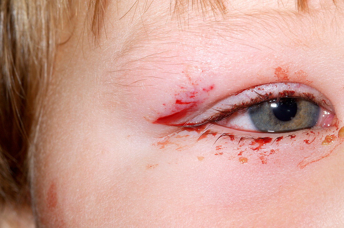 Cut eyelid