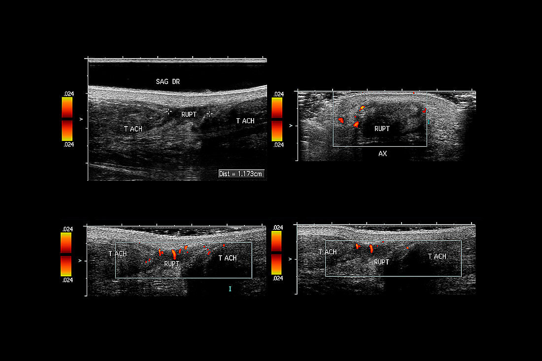 Ruptured Achilles tendon,ultrasounds