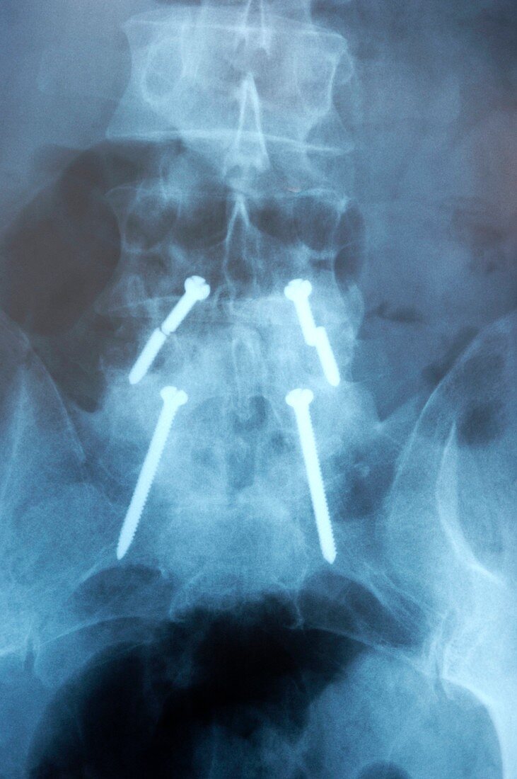 Broken screws in a patient's spine,X-ray