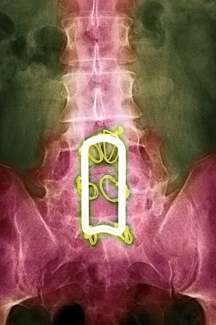 Pinned spine,X-ray