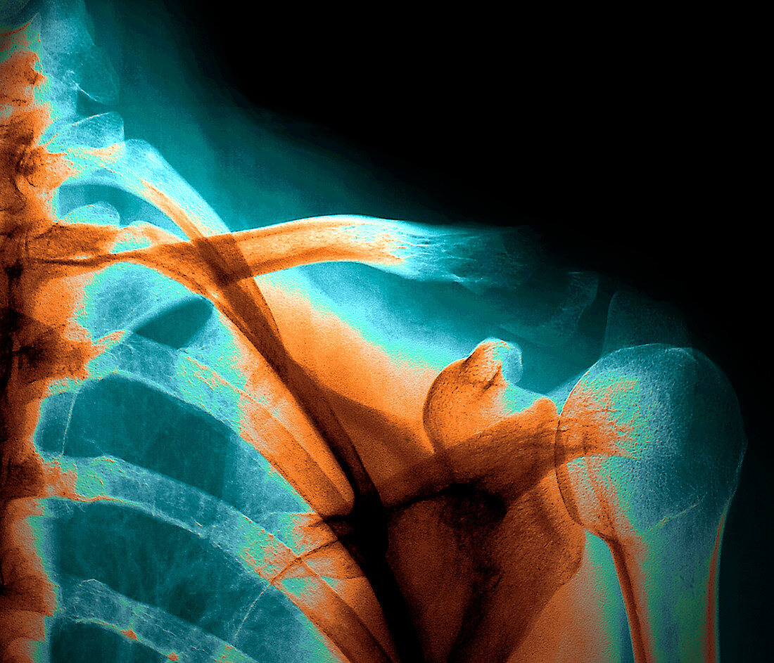 Broken collar bone,X-ray