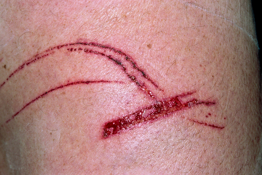 Scratched thigh