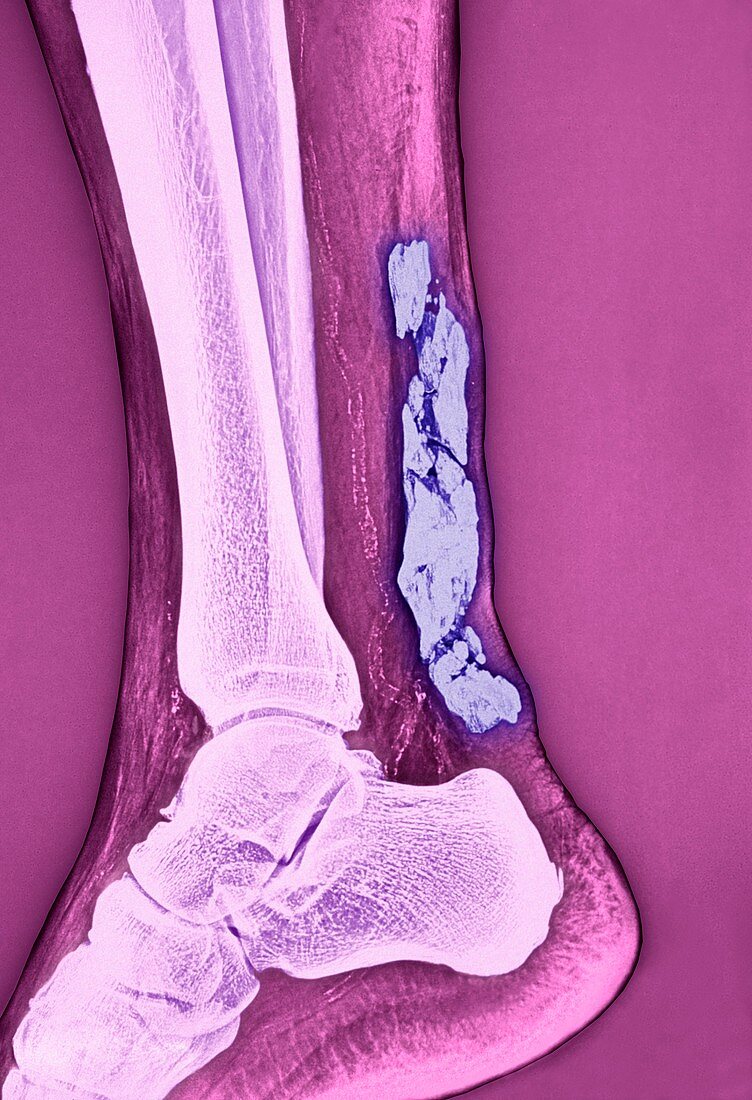 Achilles tendinitis,X-ray