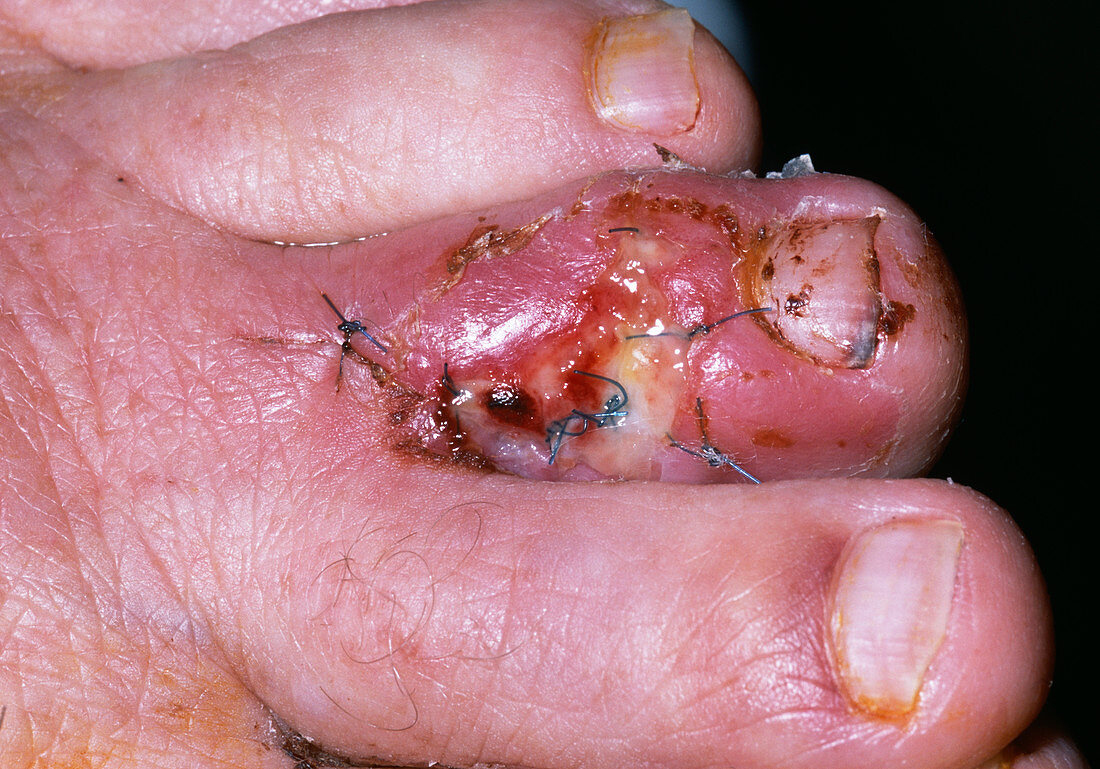 Infected surgical wound