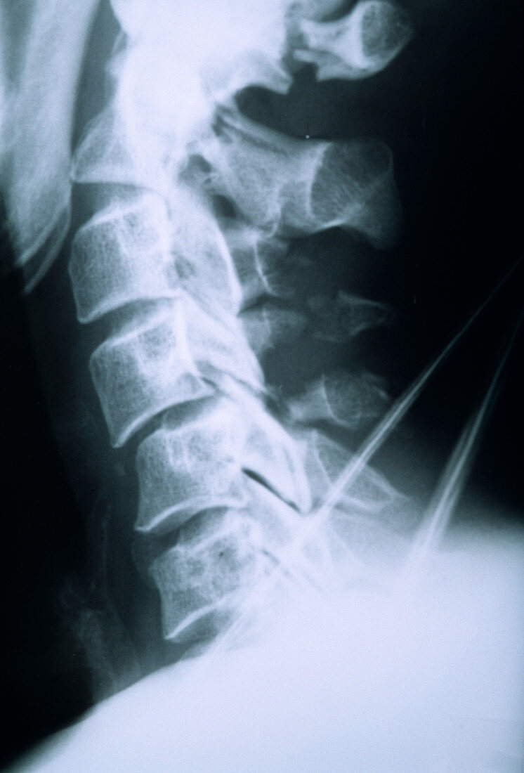 Broken neck,X-ray