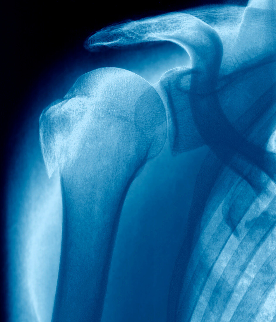 Broken upper arm bone,X-ray