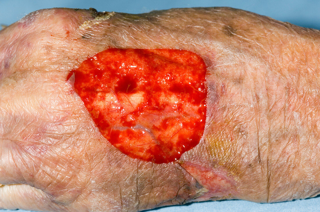 Hand wound